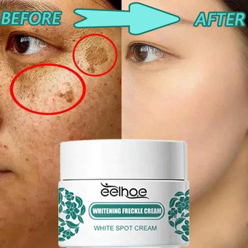 eelhoe Niacinamide Melasma Brightening Cream Reduce Melanin Lighten Dark Skin Chloasma Serum Fade Fine Lines Korean Care Product